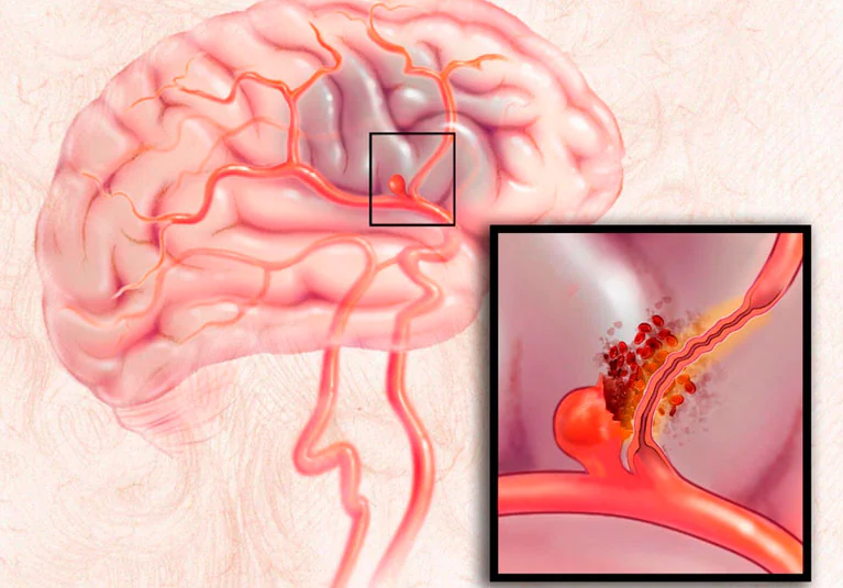 Aneurysm Clipping