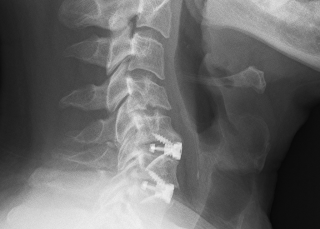 Anterior Cervical Discectomy