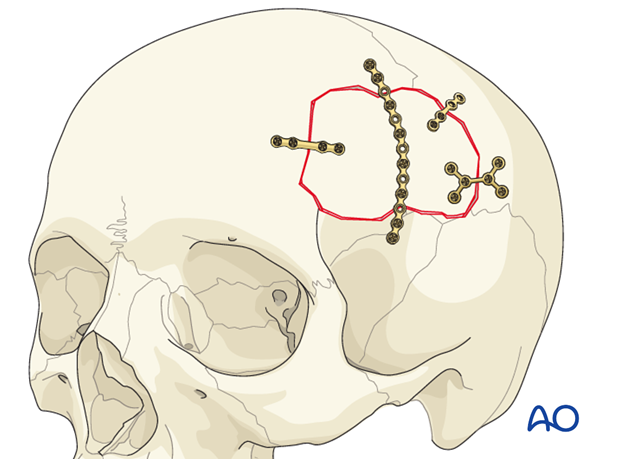 Cranioplasty Surgery by Top Neurosurgeon Dr. Sandeep Vaishya