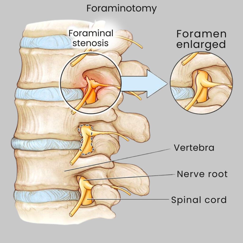 Foraminotomy