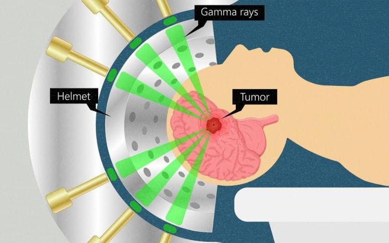 stereotactic radiosurgery