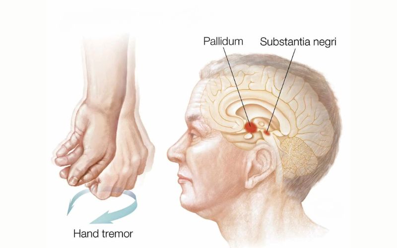 Parkinson's Disease Symptoms, Diagnosis, and Treatment Options