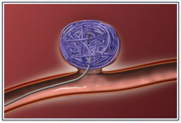 coil embolization